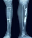 Film x-ray tibia Royalty Free Stock Photo